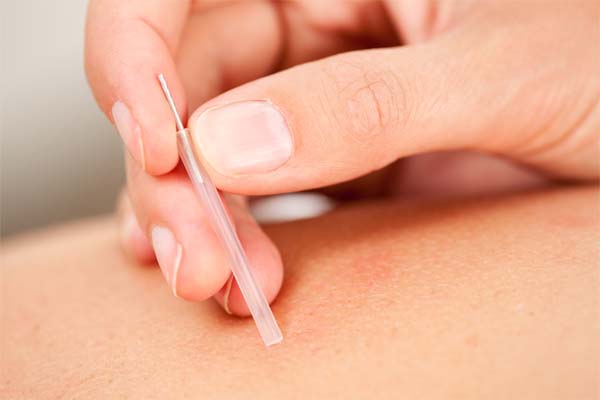 針灸輔助服務 Acupuncture